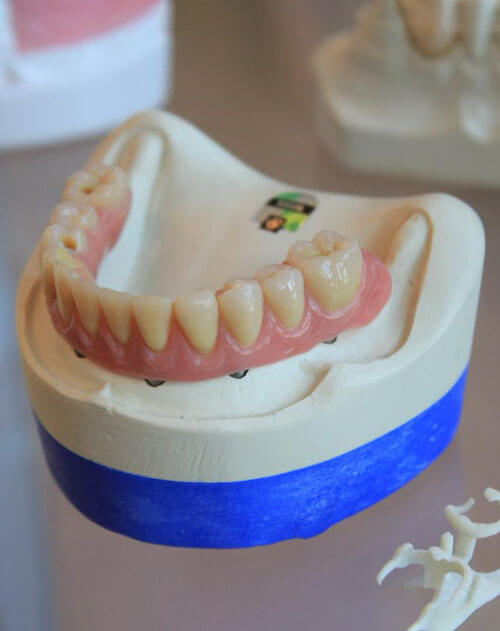 Root Canal