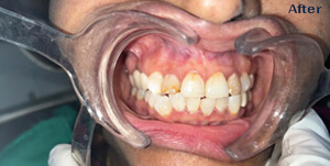 After Teeth Care