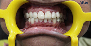 After Teeth Care