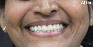 After Teeth Care